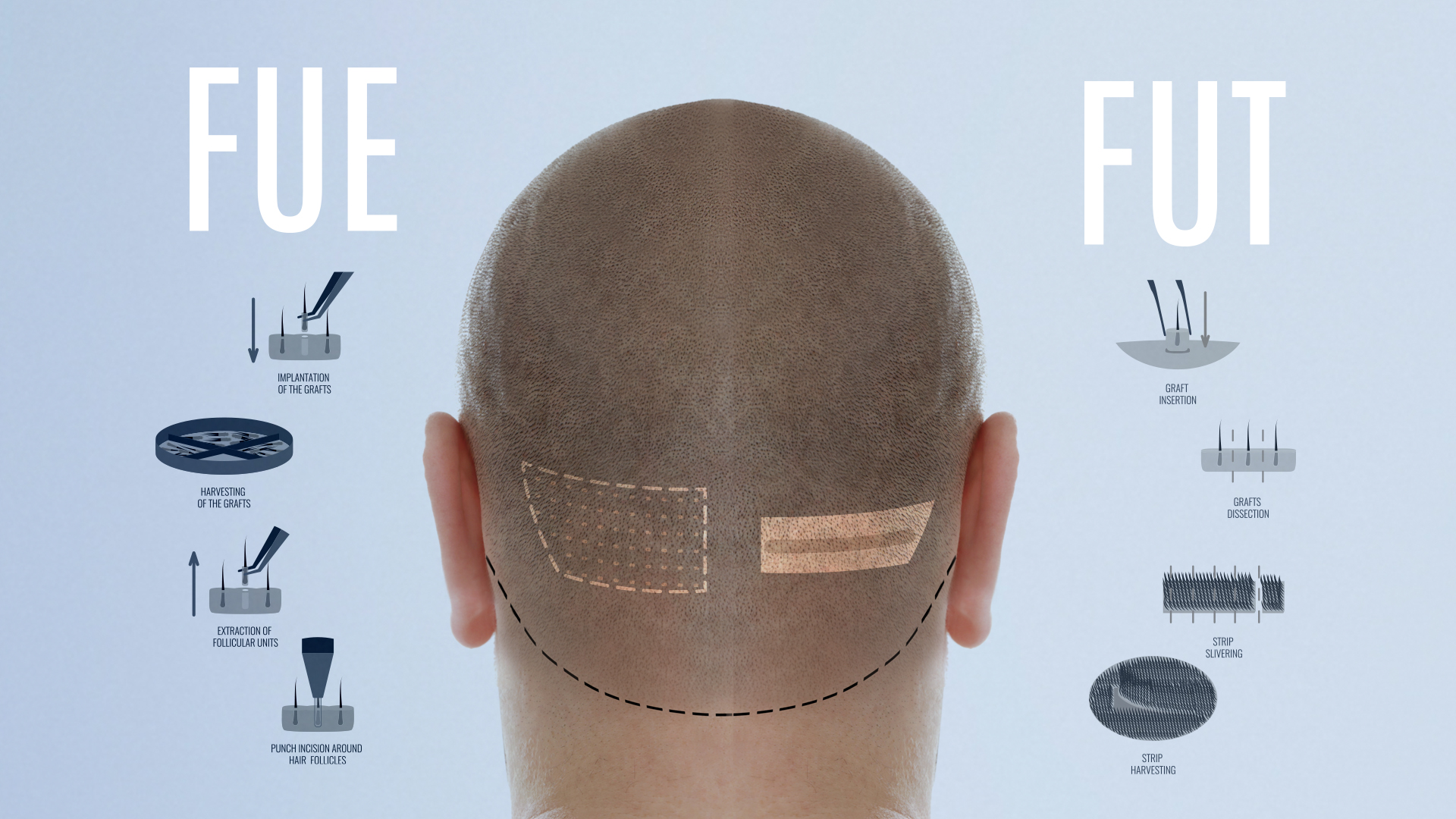 Hair Transplant Turkey: FUT and FUE