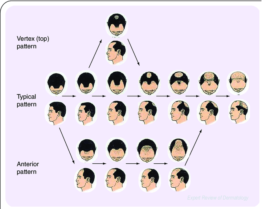 Hamilton scale for male androgenetic alopecia Norwood Hamilton scale reproduced from