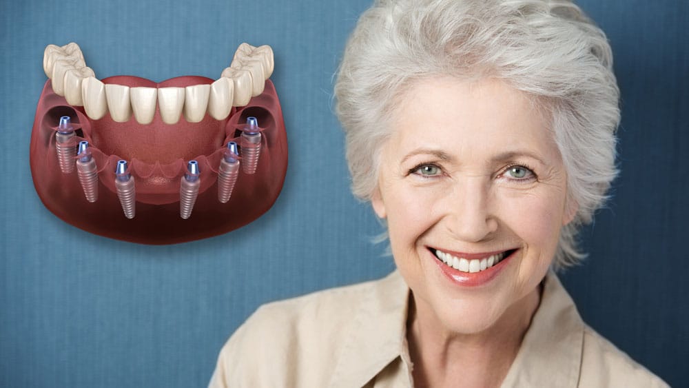 All on 6 (All on Six) Dental Procedure