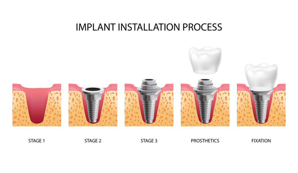 dental implant installation process renovo travel