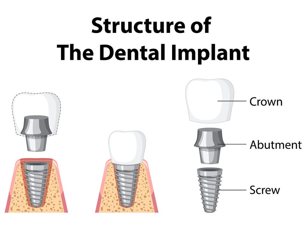 Dental Implant Structure | Dental Implants Turkey
