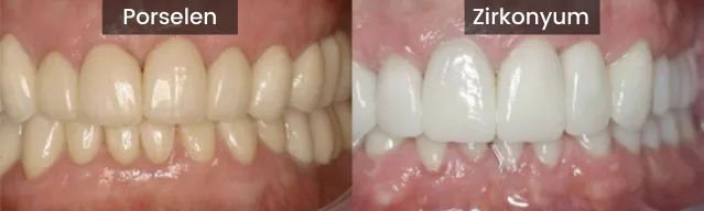 Composite Veneers Vs. Porcelain Veneers