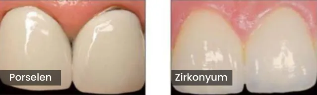 difference between zirconia and porcelain veneers 11