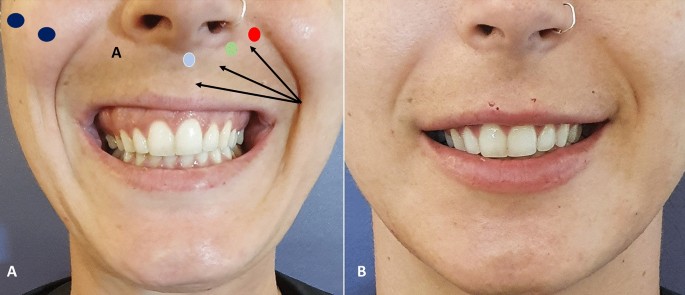 example botulin gummy smile