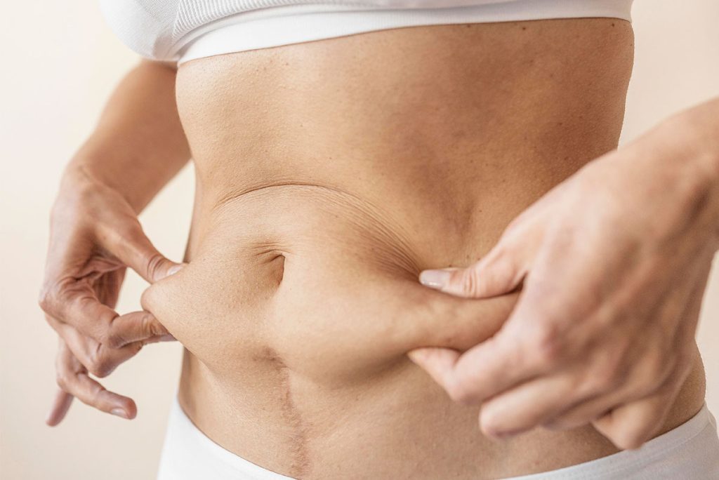 Gastric Sleeve Surgery: Bariatric Surgery