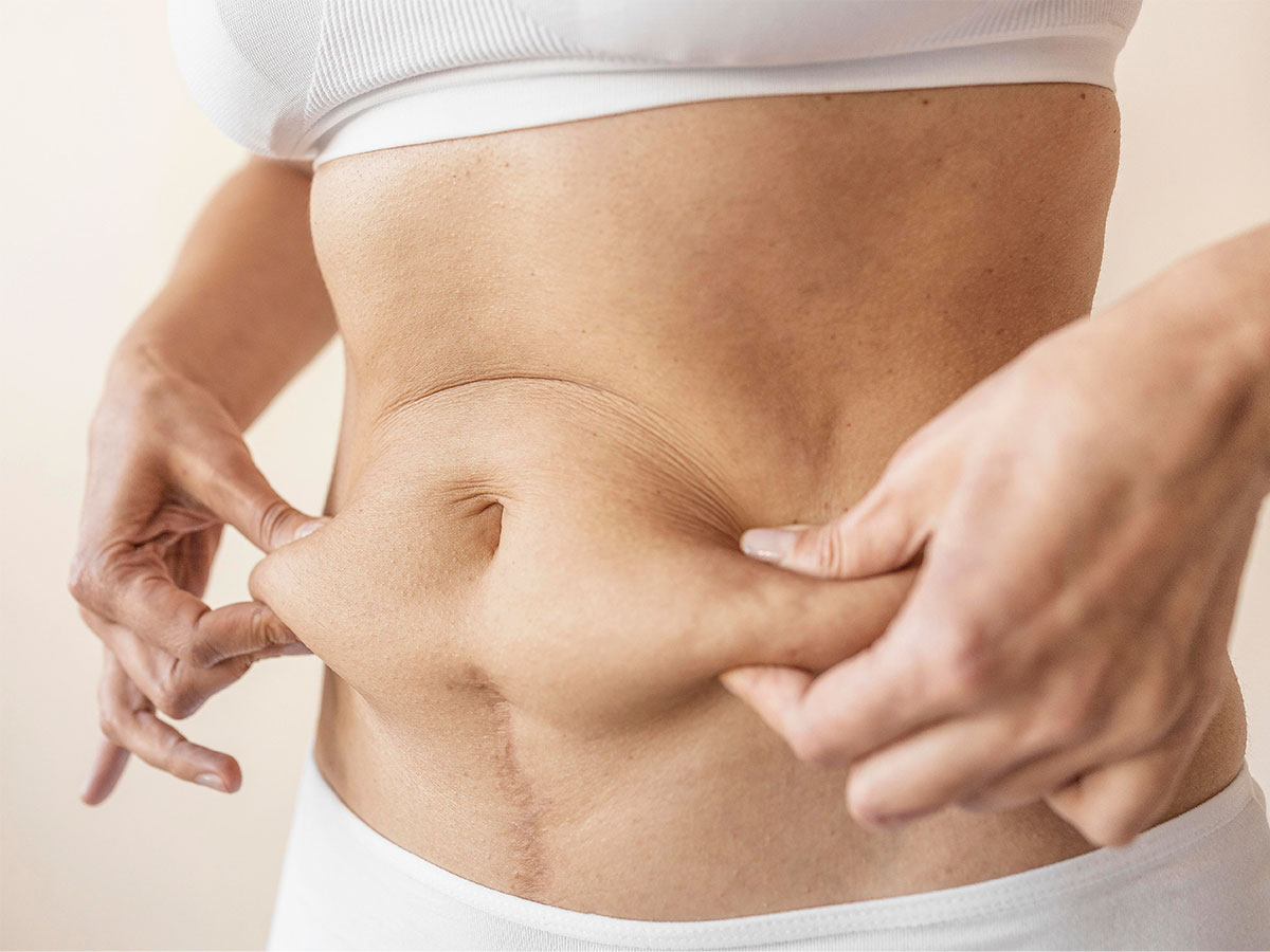 Gastric Sleeve Surgery: Bariatric Surgery