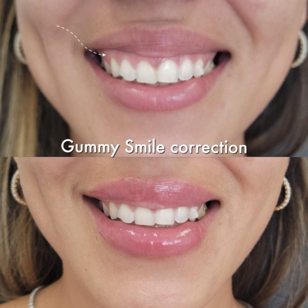 gummy smile correction renovotravel