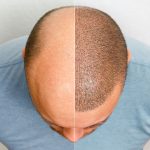 head balding man before after hair transplant surgery man losing his hair has become shaggy advertising poster hair transplant clinic treatment baldness