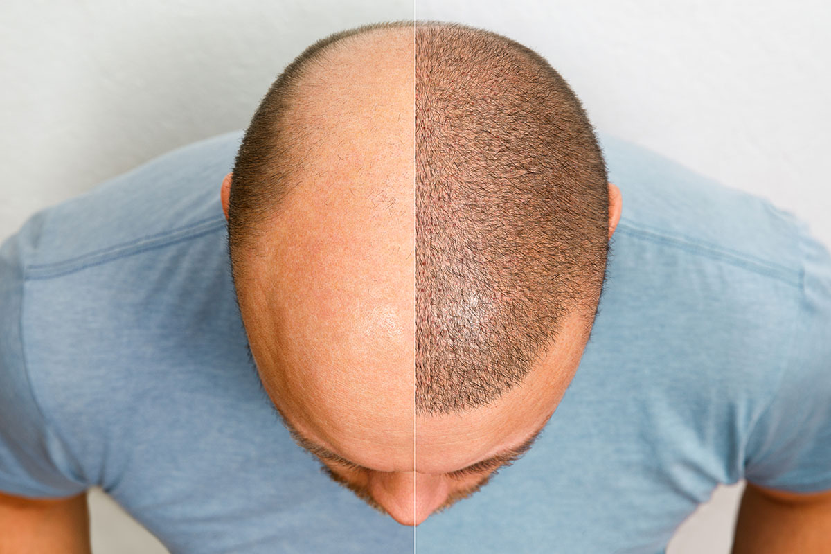 Hair Transplant in Turkey: Affordable Cost Packages