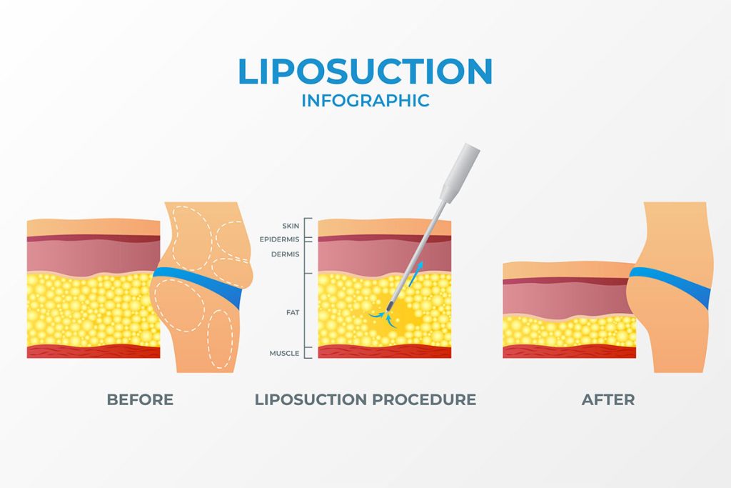 liposuction infographic renovo travel