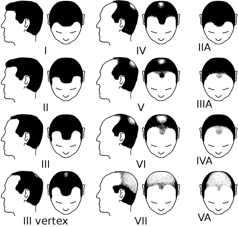 norwood scale for hair loss