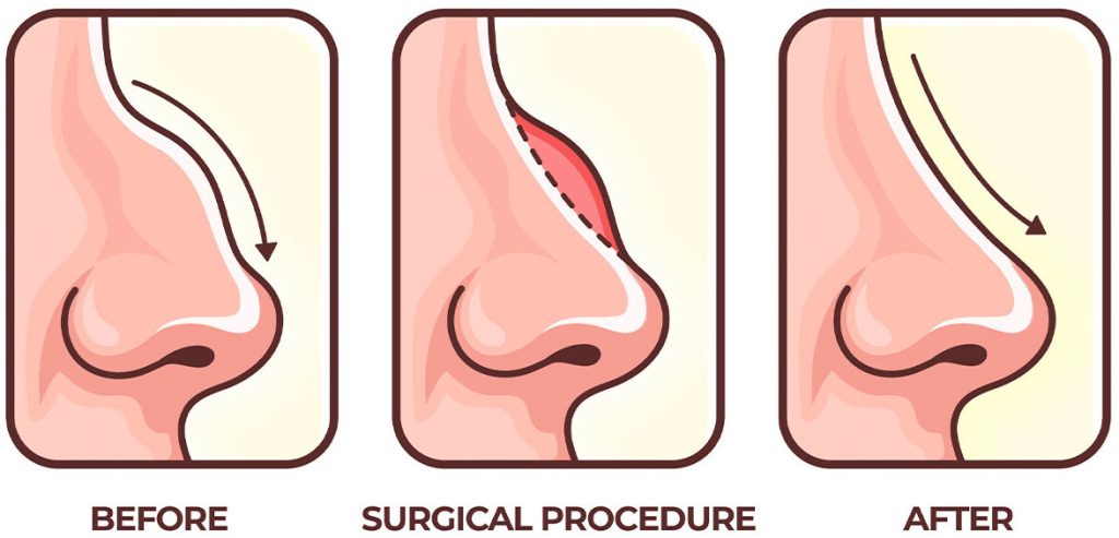 Rhinoplasty stages: Nose job turkey