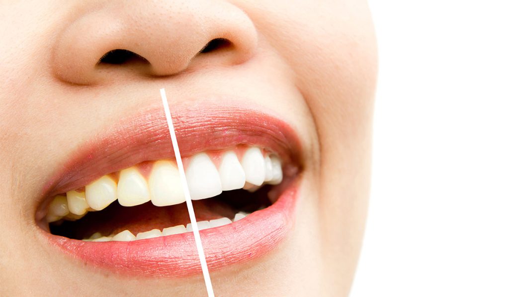 Before & After: Teeth Whitening in Turkey