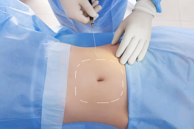 All You Ever Need to Know about Tummy Tuck Surgery in Turkey 