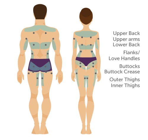 vaser liposuction body areas- back