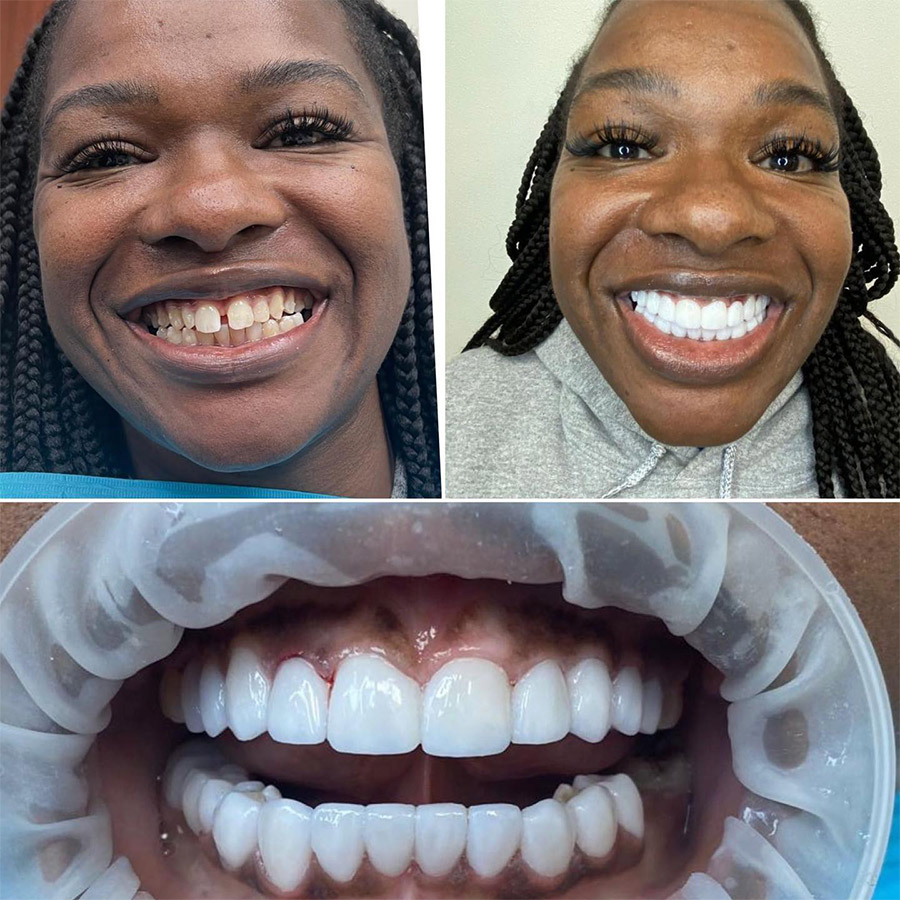 veneers before after renovo