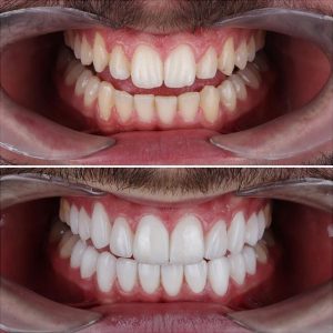 veneers treatment