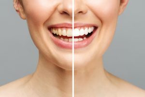 Teeth Whitening Turkey: Full Review With Costs & Benefits