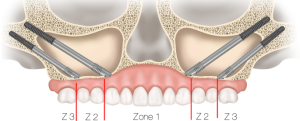 Zygomatic Implants Turkey