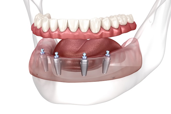 all on 4 dental implants