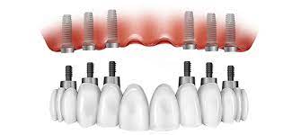 All on 6 dental implants