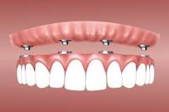 all on six dental implants