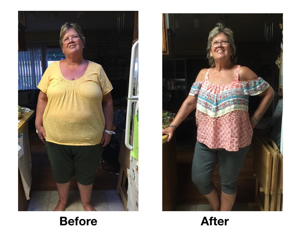 Gastric sleeve- how many pounds to loose