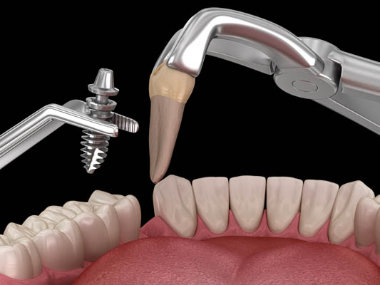 Immediate dental implants