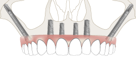 zygomatic implants